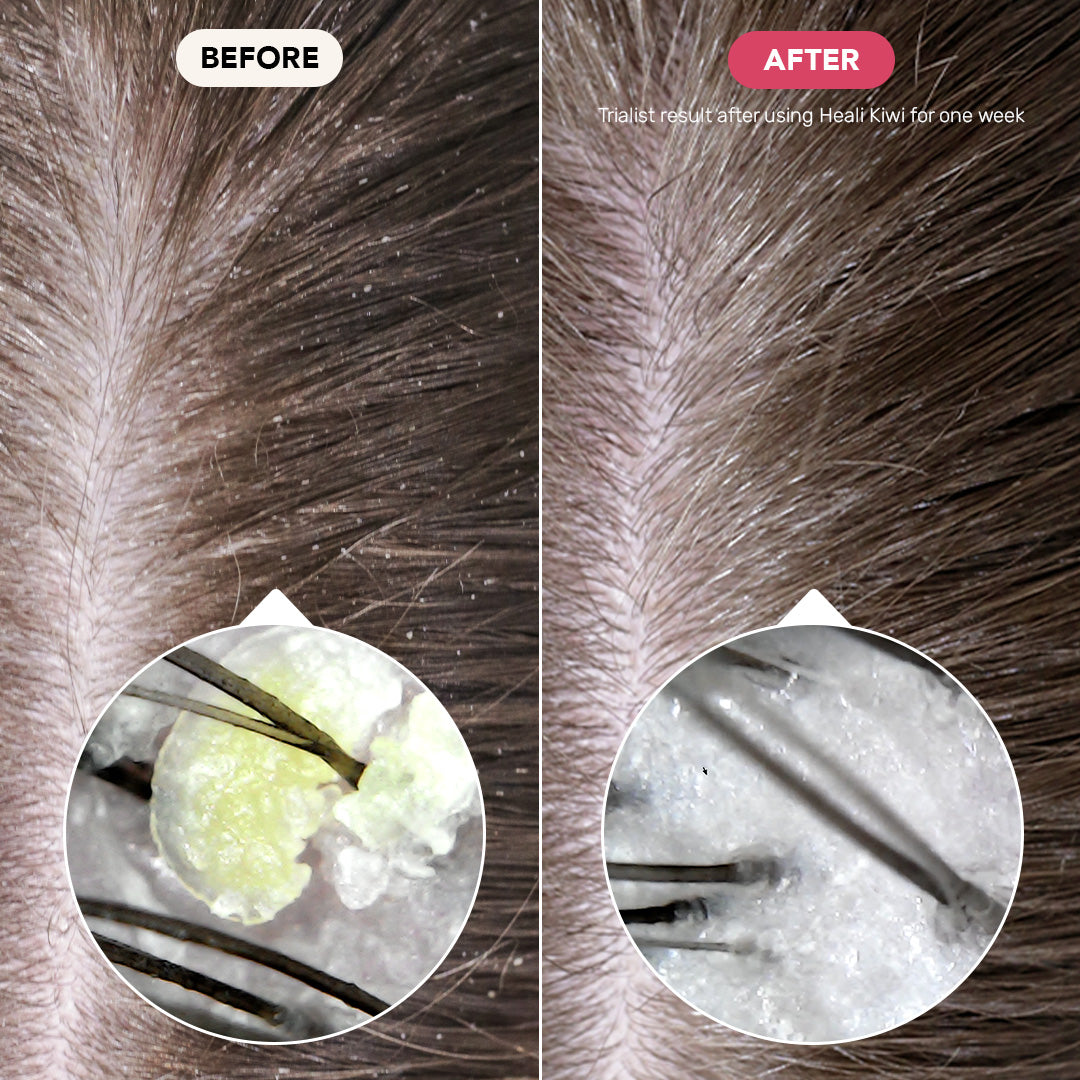 Dandruff Shampoo Bar - Heali Kiwi™ | Ethique🌱